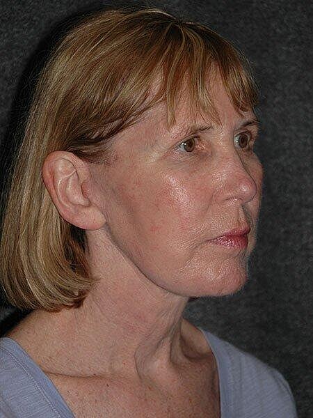 Facelift Neck Lift Before & After