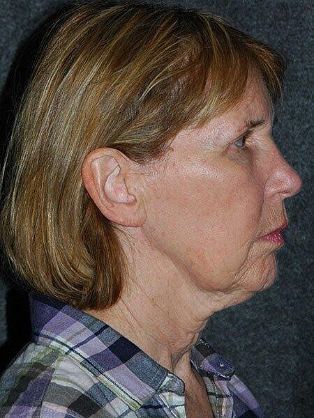 Facelift Neck Lift Before & After