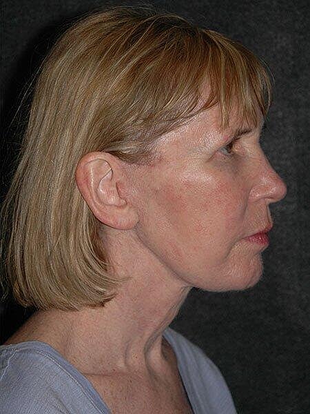 Facelift Neck Lift Before & After