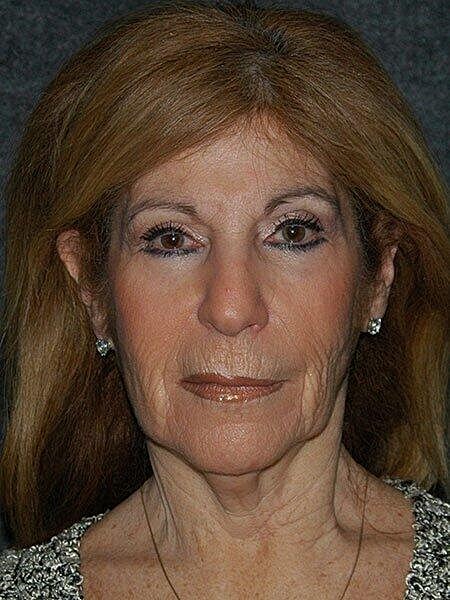 Facelift Neck Lift Before & After