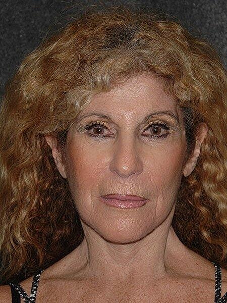 Facelift Neck Lift Before & After