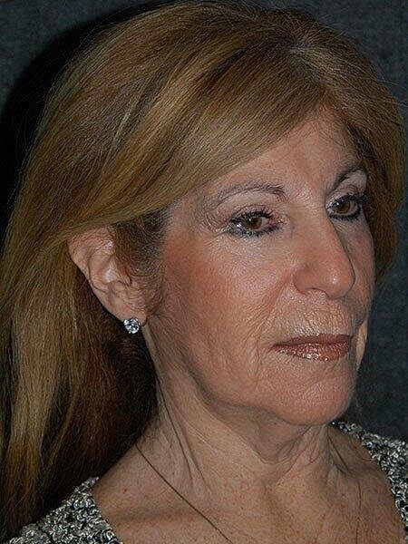 Facelift Neck Lift Before & After