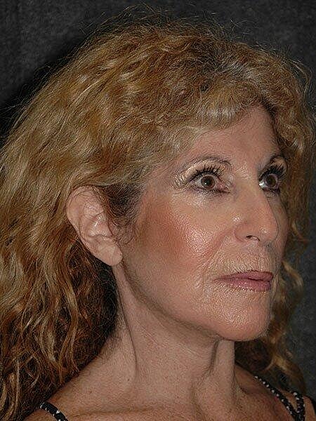 Facelift Neck Lift Before & After