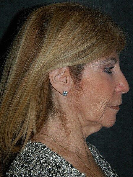 Facelift Neck Lift Before & After