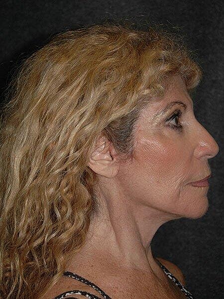 Facelift Neck Lift Before & After