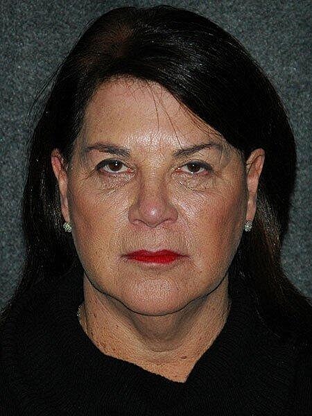 Facelift Neck Lift Before & After