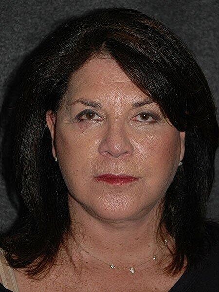 Facelift Neck Lift Before & After