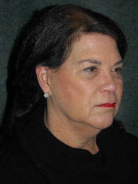 Facelift Neck Lift Before & After