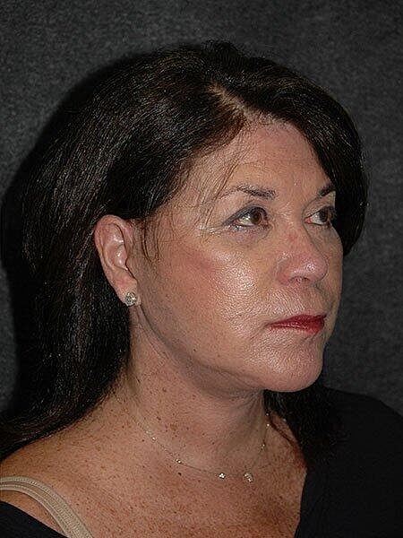 Facelift Neck Lift Before & After