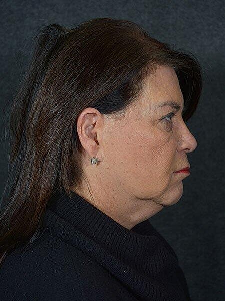 Facelift Neck Lift Before & After