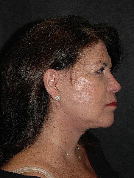 Facelift Neck Lift Before & After