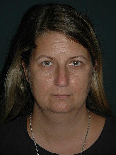 Facelift Neck Lift Before & After