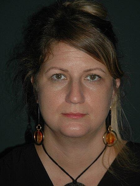 Facelift Neck Lift Before & After