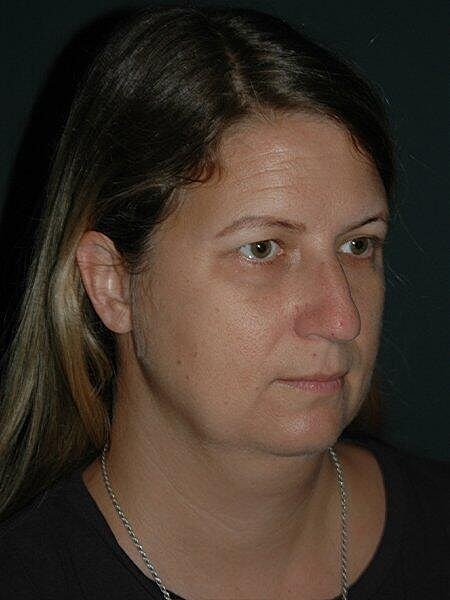 Facelift Neck Lift Before & After