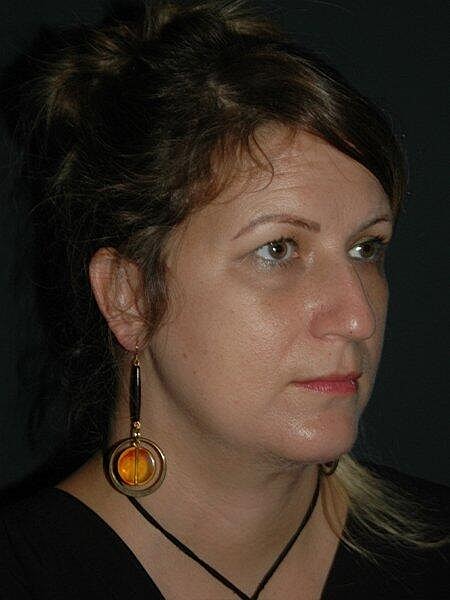 Facelift Neck Lift Before & After