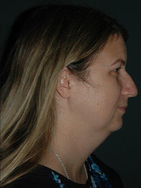 Facelift Neck Lift Before & After