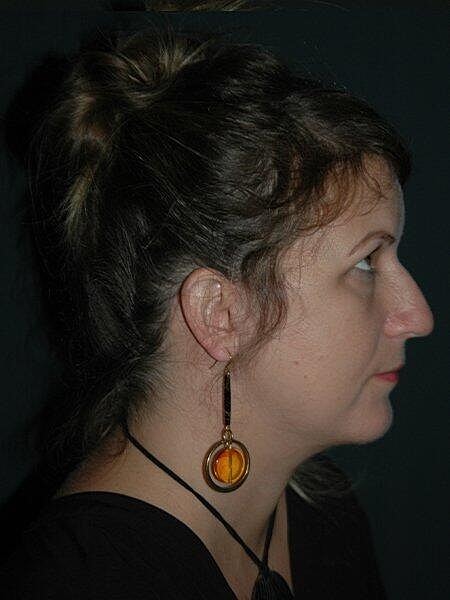 Facelift Neck Lift Before & After