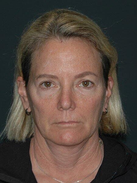 Facelift Neck Lift Before & After