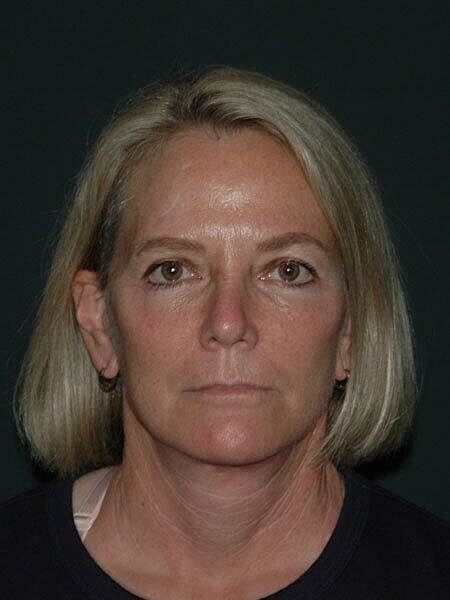Facelift Neck Lift Before & After