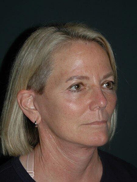 Facelift Neck Lift Before & After