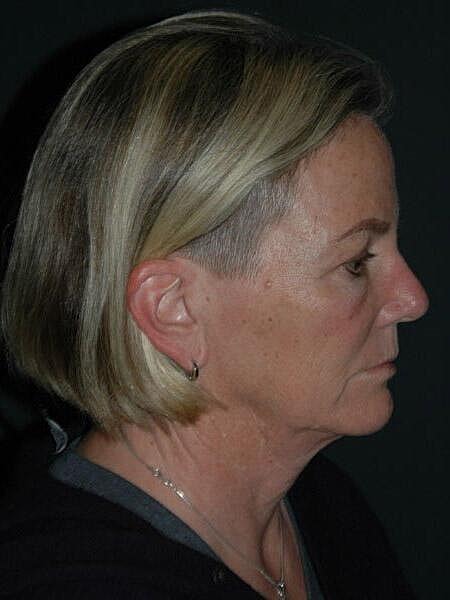 Facelift Neck Lift Before & After