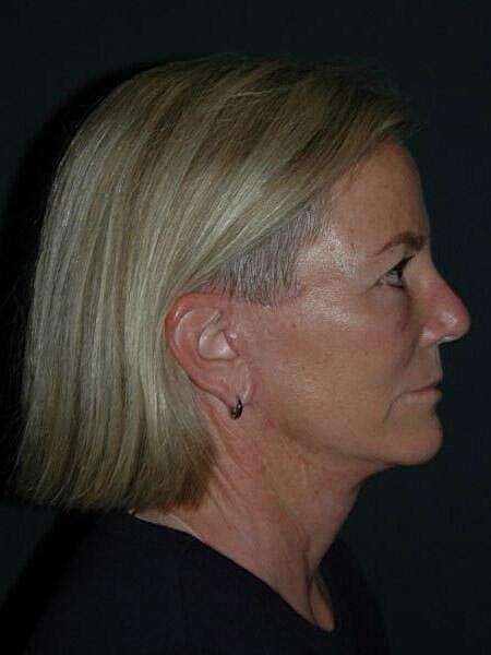 Facelift Neck Lift Before & After