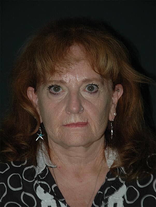 Facelift Neck Lift Before & After