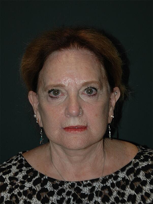 Facelift Neck Lift Before & After