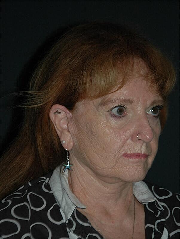 Facelift Neck Lift Before & After