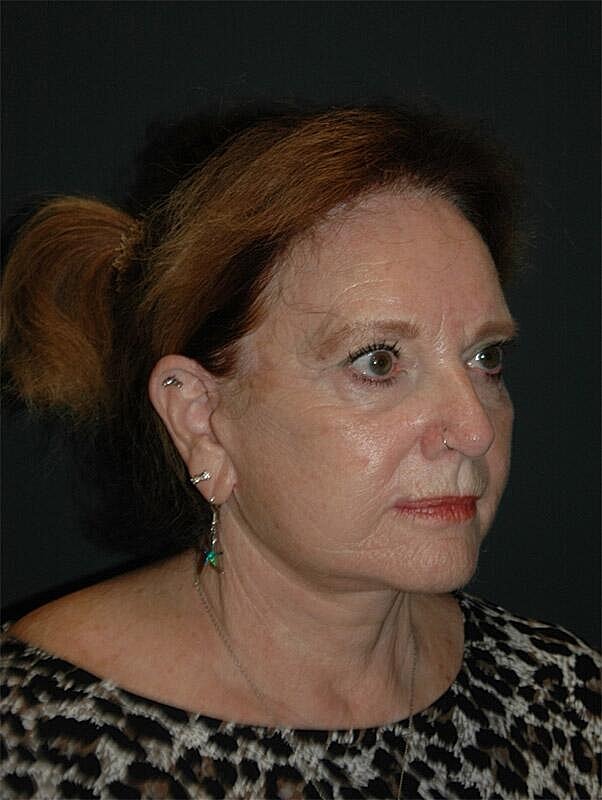 Facelift Neck Lift Before & After
