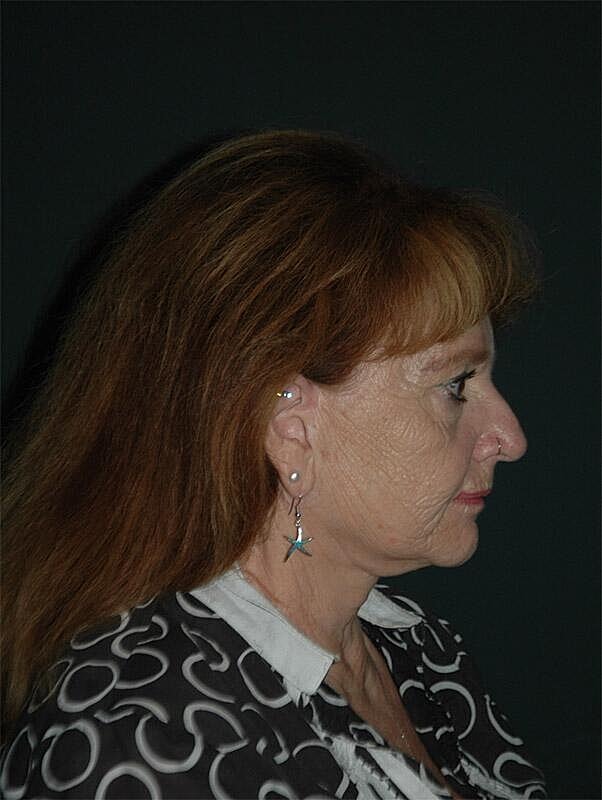 Facelift Neck Lift Before & After
