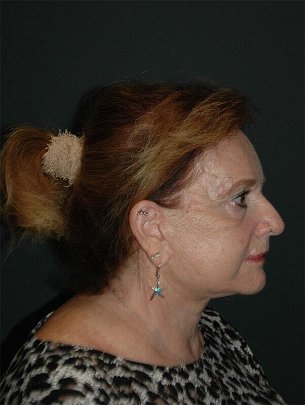 Facelift Neck Lift Before & After