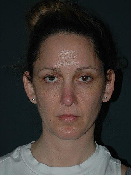 Facelift Neck Lift Before & After