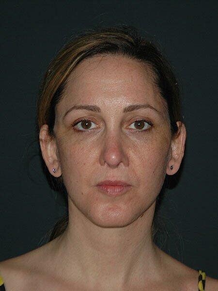 Facelift Neck Lift Before & After