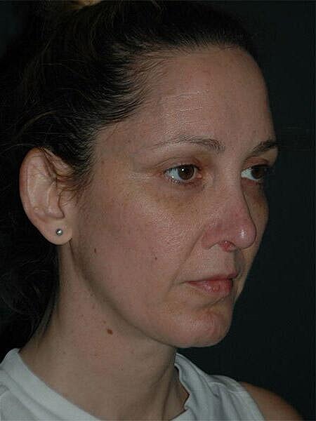 Facelift Neck Lift Before & After