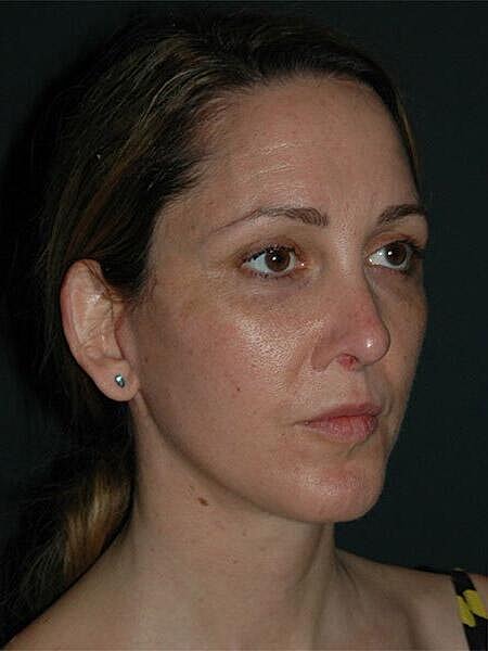 Facelift Neck Lift Before & After