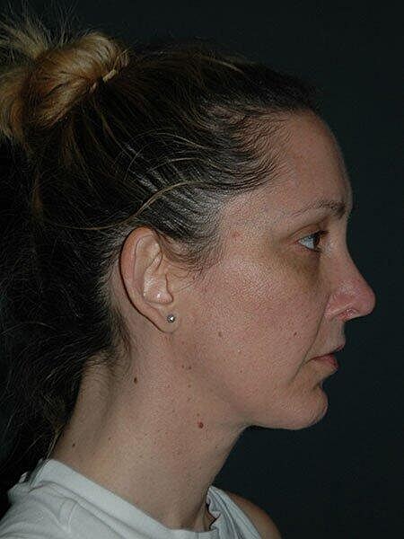 Facelift Neck Lift Before & After