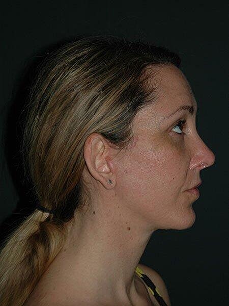Facelift Neck Lift Before & After