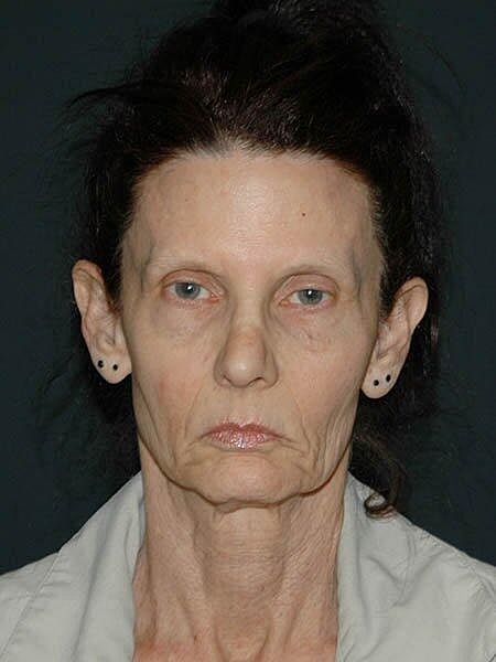 Facelift Neck Lift Before & After