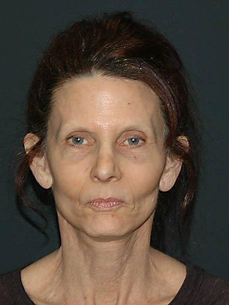 Facelift Neck Lift Before & After