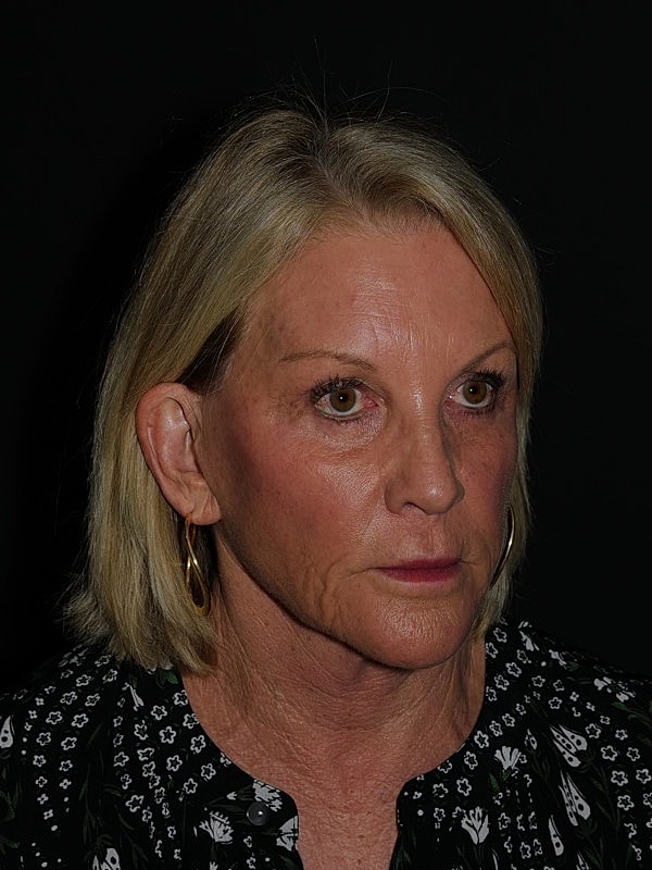 Facelift Neck Lift Before & After