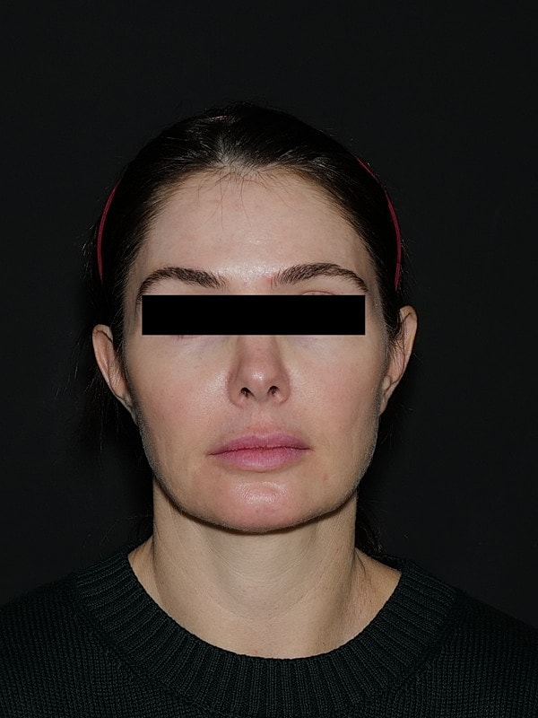 Facelift Neck Lift Before & After