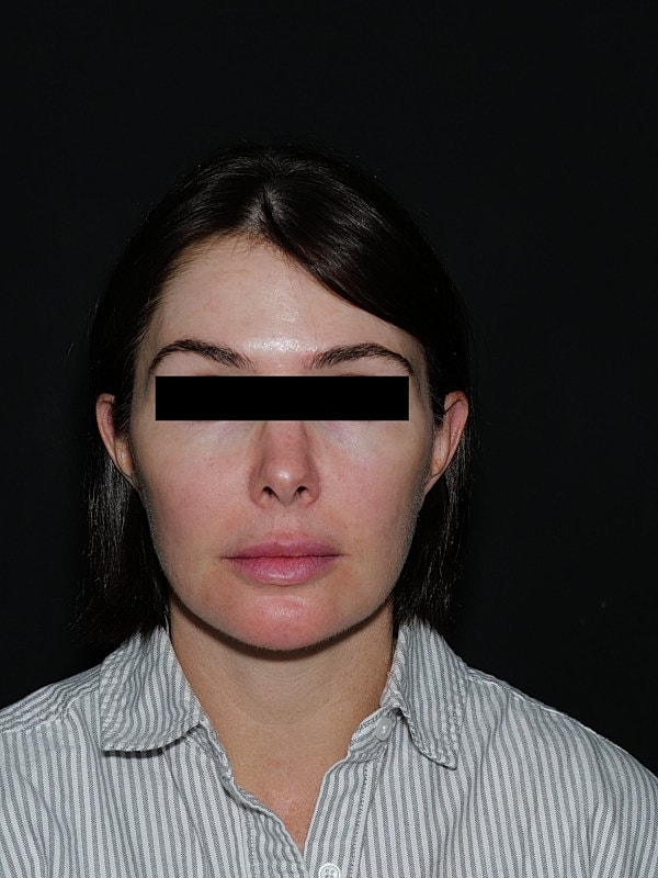 Facelift Neck Lift Before & After