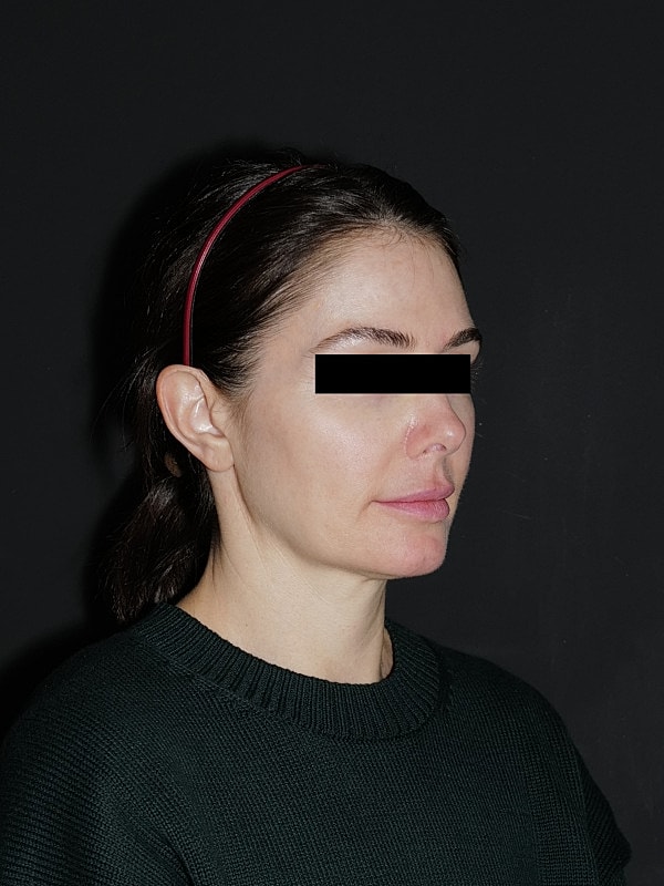Facelift Neck Lift Before & After