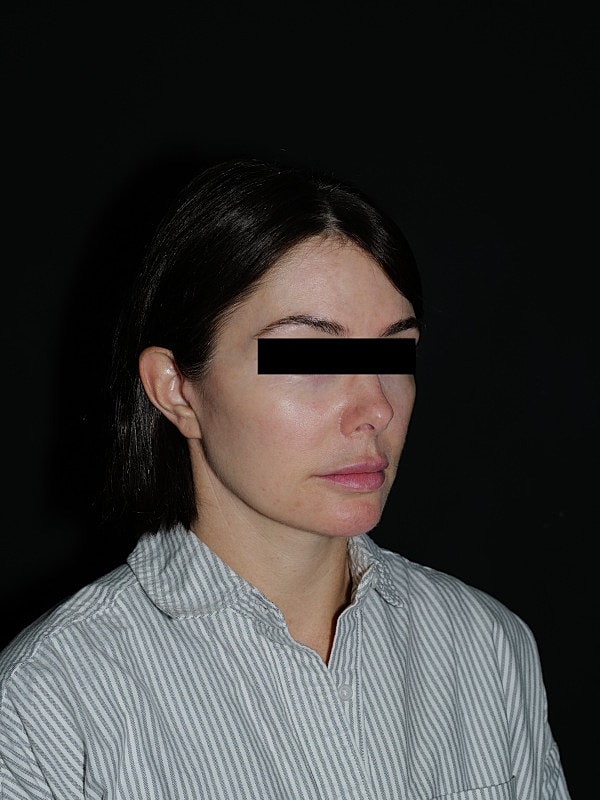 Facelift Neck Lift Before & After