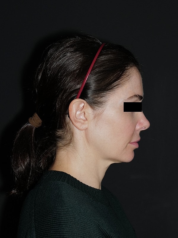 Facelift Neck Lift Before & After