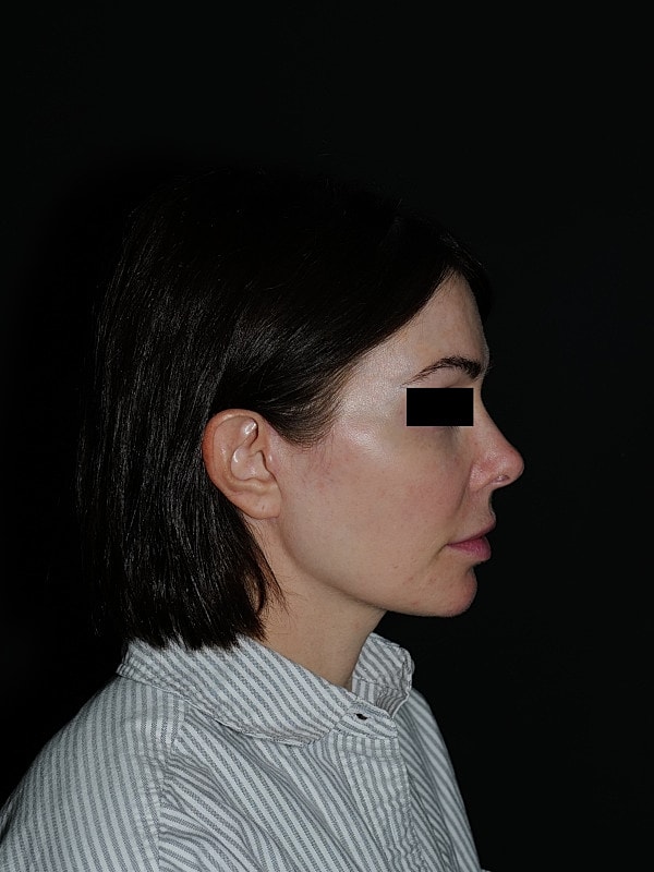 Facelift Neck Lift Before & After