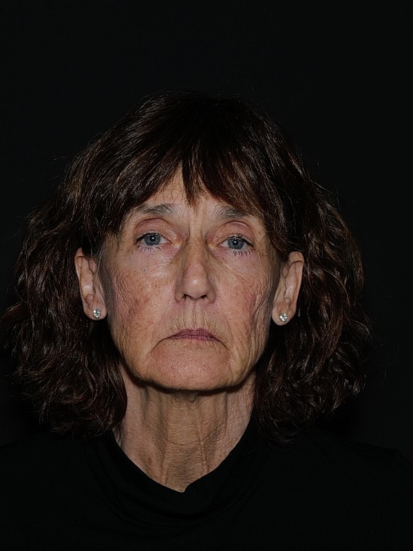 Facelift Neck Lift Before & After
