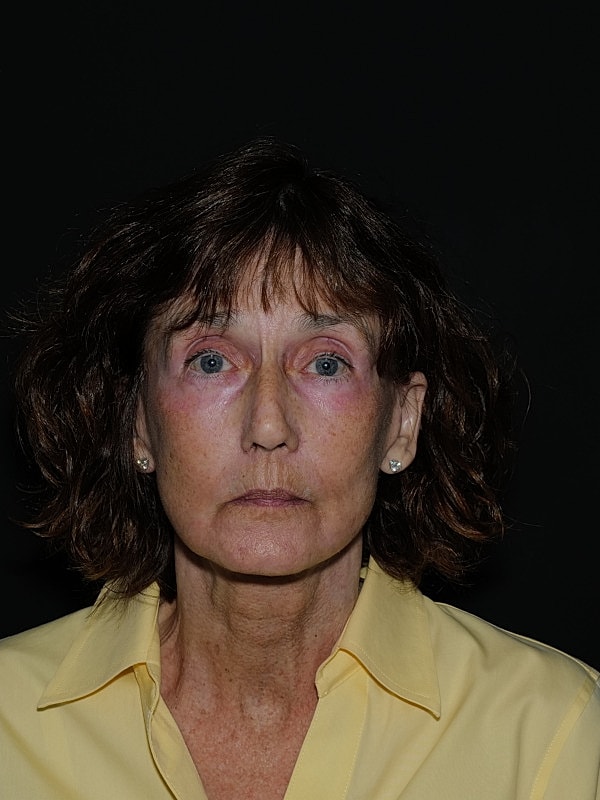 Facelift Neck Lift Before & After