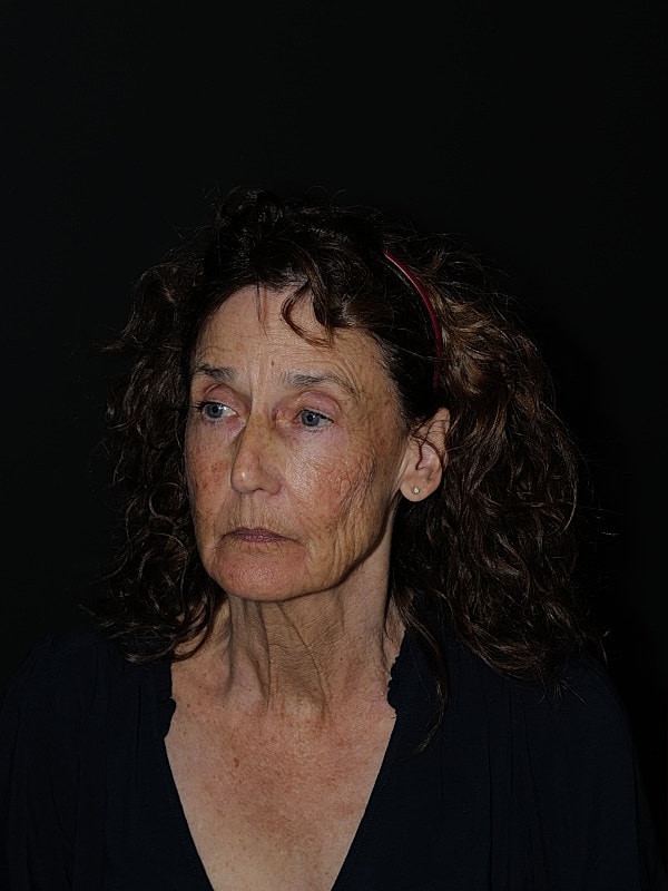 Facelift Neck Lift Before & After
